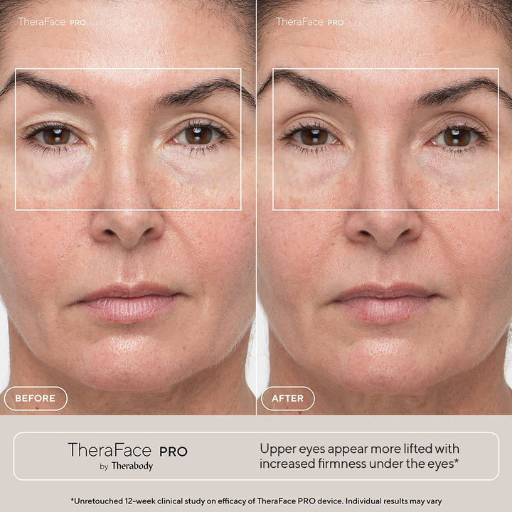 Masajeador facial Therabody Theraface Pro para terapia y cuidado de la piel - Achorao